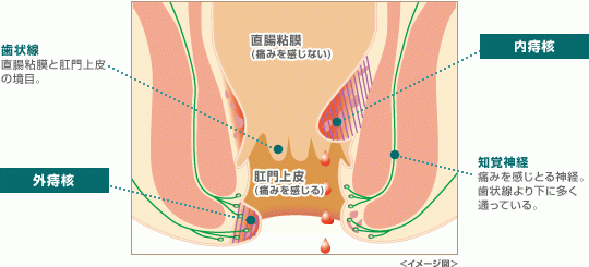 いぼ痔