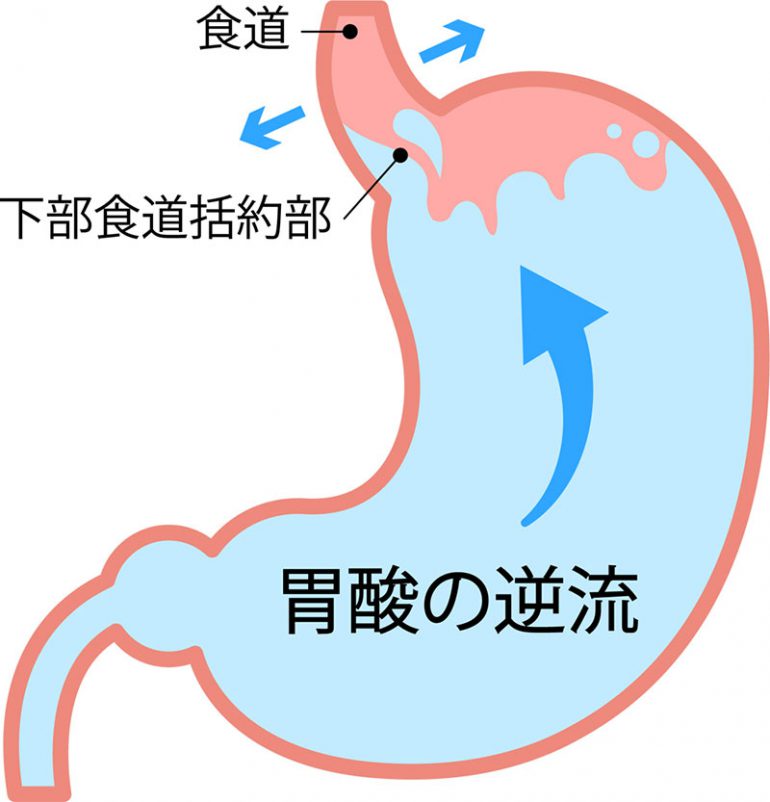 逆流性食道炎